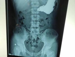 Pria Indramayu Makan 70 Paku Usai Disakiti Perempuan