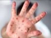 WHO Tetapkan Mpox sebagai Keadaan Darurat Kesehatan Global