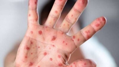 WHO Tetapkan Mpox sebagai Keadaan Darurat Kesehatan Global